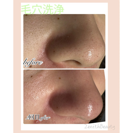 毛穴洗浄1回よりも2回3回目の効果に期待‼️
